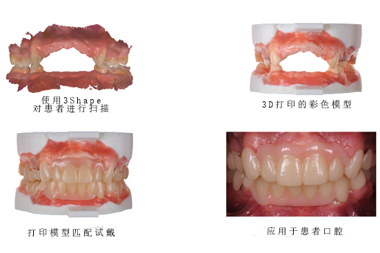 3Shape彩色工作流程，讓牙齒假體越來越“真”！